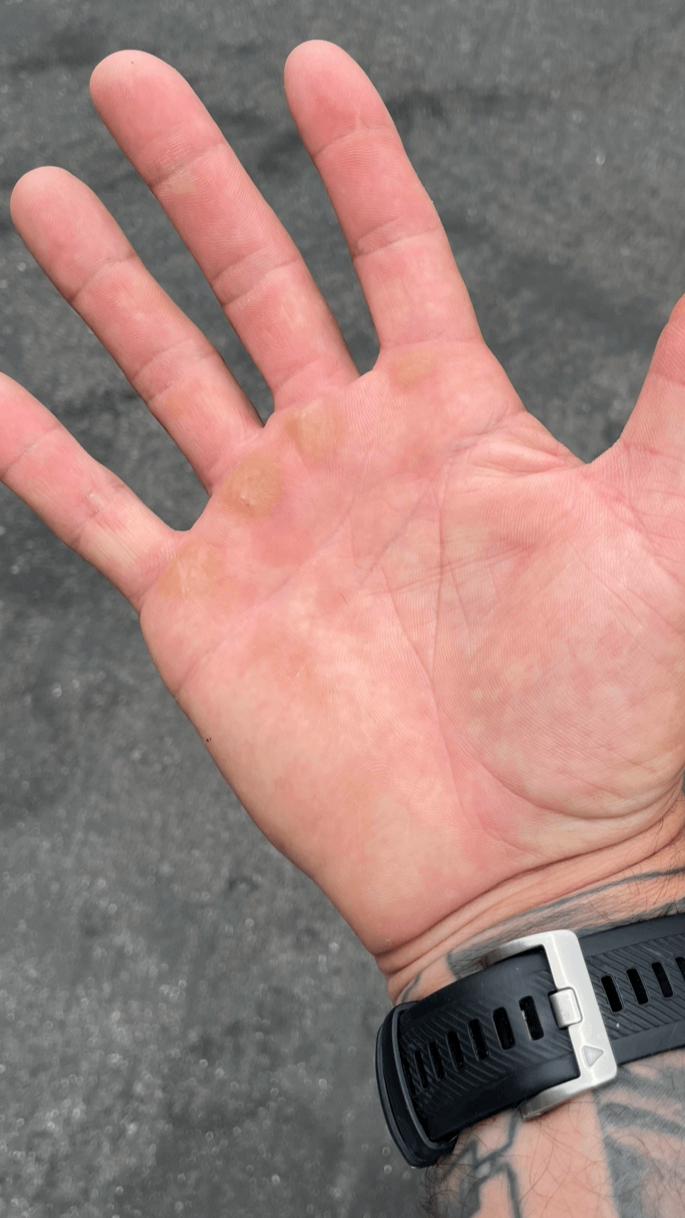 Tough hand repaired from heavy handed