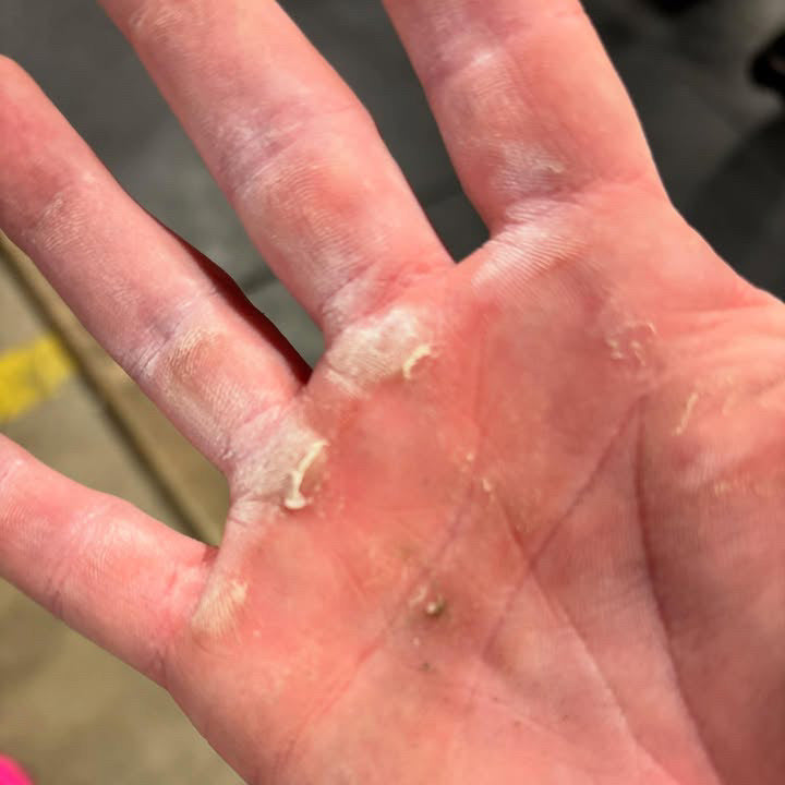 Calluses Aren’t the Problem — But Ignoring Them Is