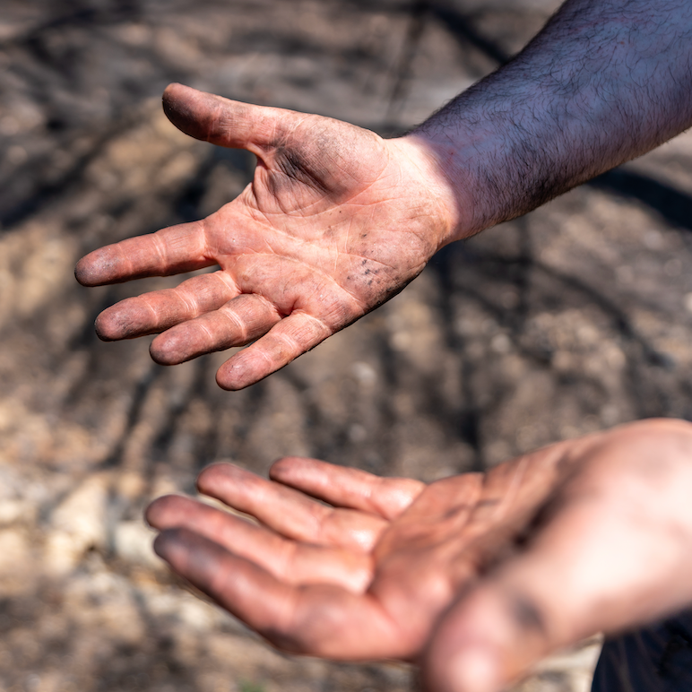 Why Are My Hands So Dry and Cracked?